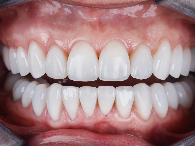 Estética Dental — Clareamento, Facetas em Resina e Tratamentos Estéticos