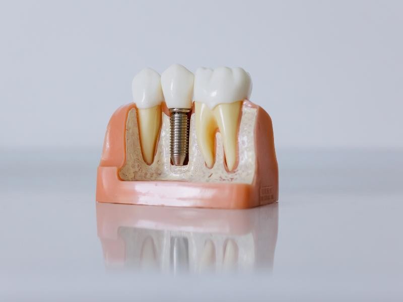 Próteses Odontológicas em Goiânia