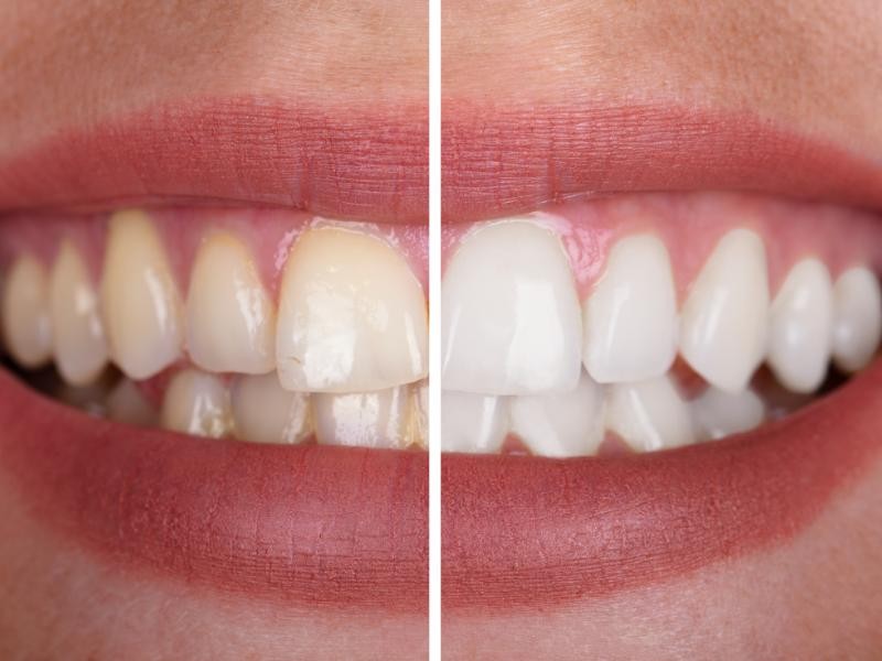Clareamento Dental em Goiânia (caseiro e consultório)